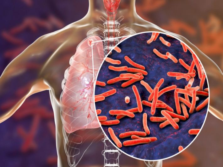 أحدث 3 طرق علاج مرض السل