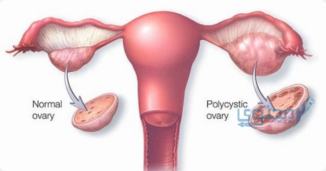 أشهر 10 علامات تدل على تكيس المبايض 