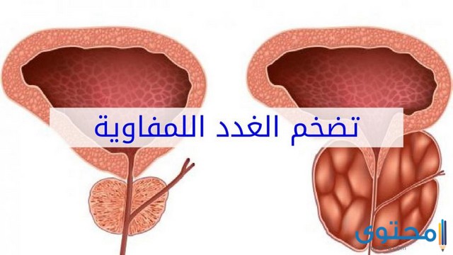 ما هي أعراض سرطان الغدد الليمفاوية