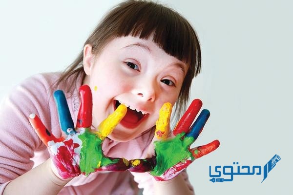 حالات شفيت من متلازمة داون