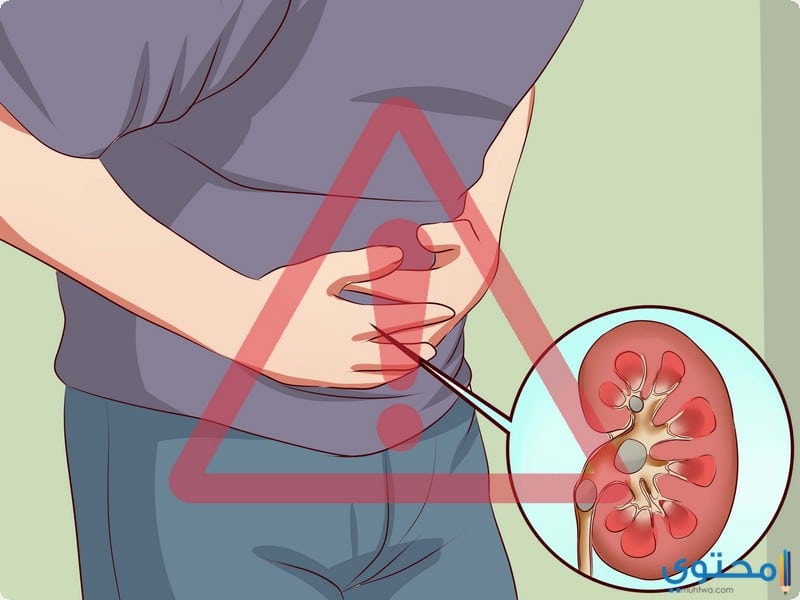 طريق علاج حصي الكلي بالاعشاب ونصائح للوقاية منها