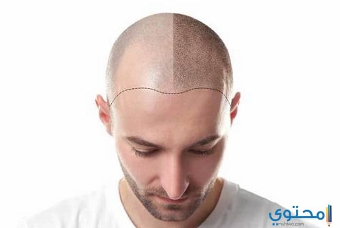 مراكز وأسعار زراعة الشعر في اسطنبول