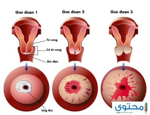 ما هي أعراض سرطان الرحم