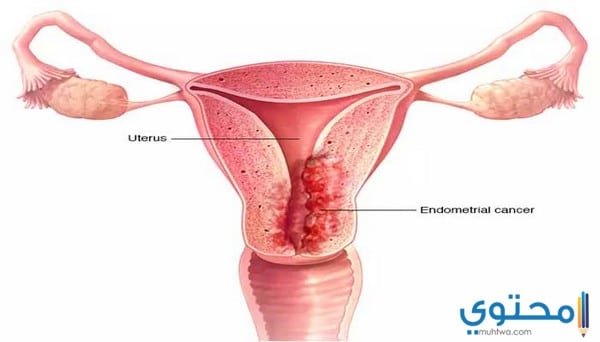 ما هي أعراض سرطان الرحم