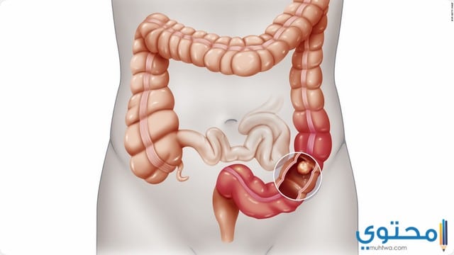 علاج سرطان القولون بطرق حديثة