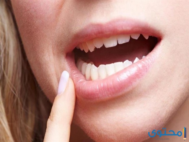 علاج التهاب اللثة