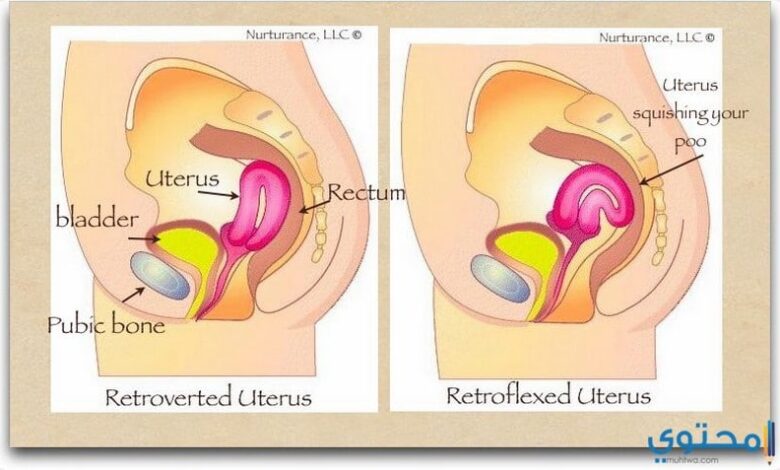 طرق علاج الرحم المقلوب وعلاقتة باللولب والجماع والحمل