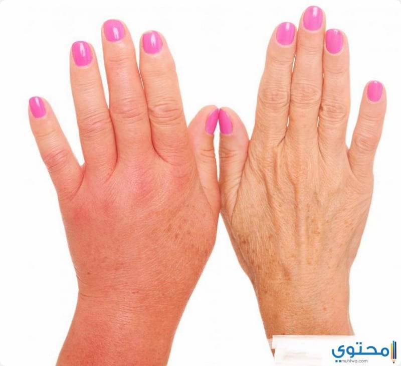 علاج تورم وانتفاخ القدمين