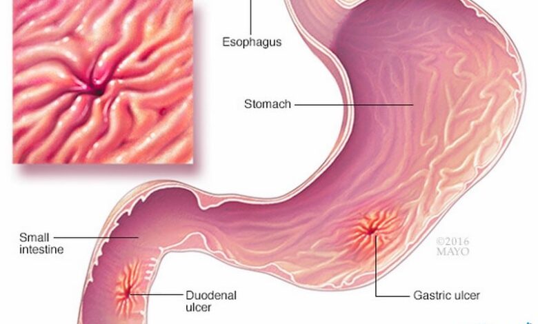 طرق علاج قرحة المعدة بالأدوية والأعشاب