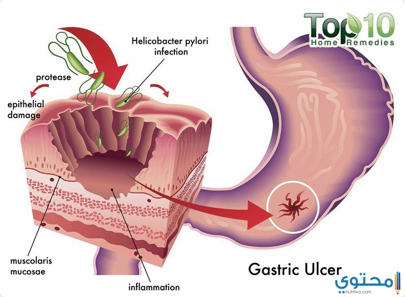 أماكن ظهور قرحة المعدة
