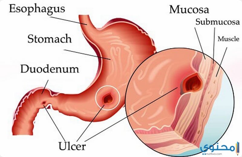 كيفية تشخيص قرحة المعدة