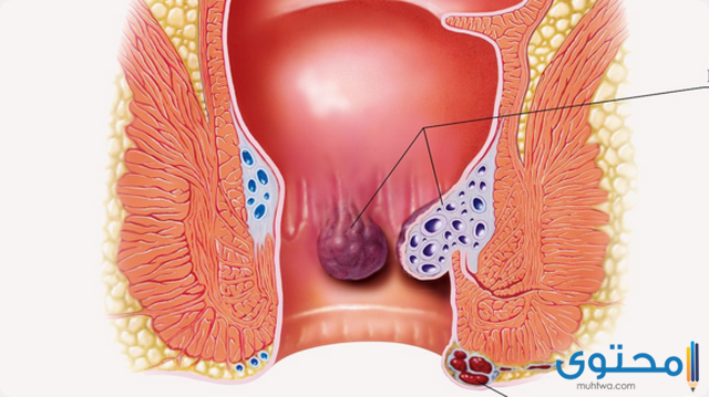 كيف تختفي البواسير الخارجية
